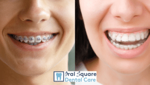 Braces Versus Aligners