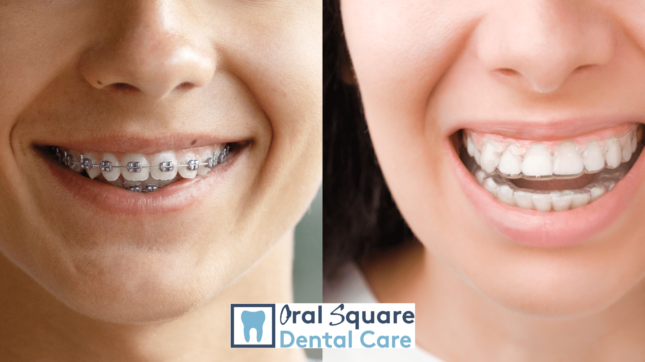 Braces Versus Aligners