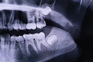 Panoramic X-ray of the jaw