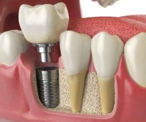 Implant image